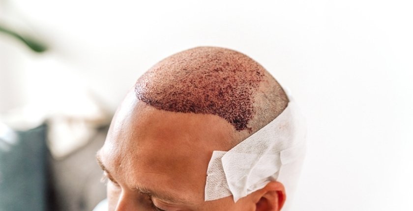 Hair Transplant In Turkey